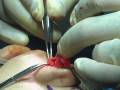 videos de Rhinoplasty In the Operating Room - Columella Strut Placement