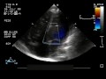 Perimembranous ventricular Septal Defect with Severe Tricuspid Regurgitation