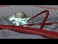 Angiogenesis