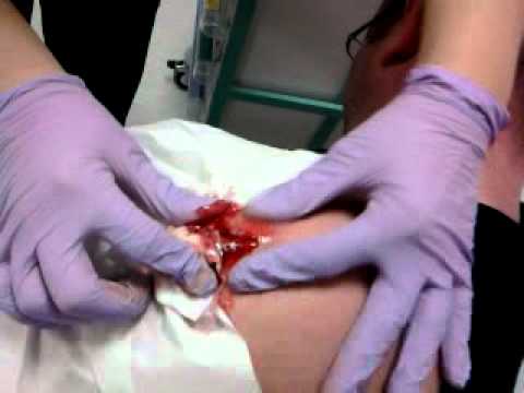 Simo's Pus-filled Arm