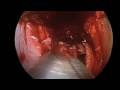 Endoscopic Rhinoplasty and Septoplasty Endoscopic Rhinoplasty and Septoplasty