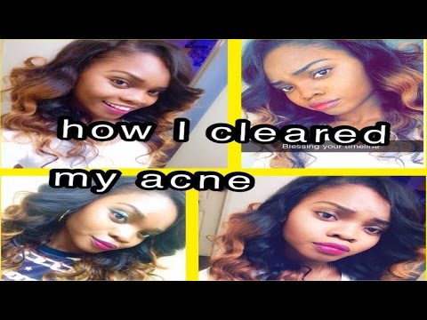 My acne scars are GONE ! African Black soap, Best treatment for Acne and Acne scars !!!