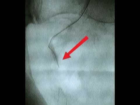 how to dissolve existing kidney stones