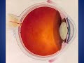 What is Central Retinal Vein Occlusion? (CRVO) What is Central Retinal Vein Occlusion? (CRVO)