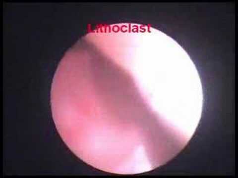 Ureteroscopy for Stone