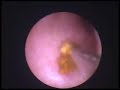 Ureteroscopy for Stone