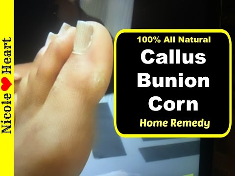 old lady bunions