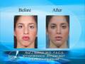 videos de Rhinoplasty - A Surgery of Millimeters