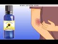 Eczema Treatment, Psoriatic Eczema Treatment