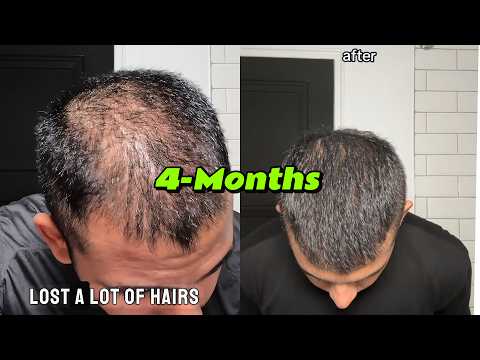 How I Reversed Hair Loss | 4 Months |  LifeOfNiravPatel