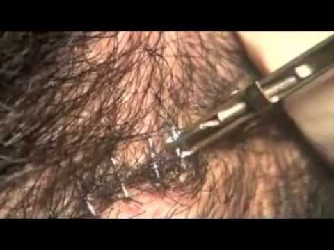 how to remove scabs after hair transplant