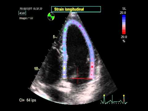 how to measure ejection fraction ultrasound