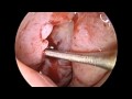 Endoscopic Drainage of Hypoplastic Maxillary Sinus Endoscopic Drainage of Hypoplastic Maxillary Sinus