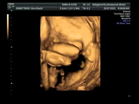 Baby girl 4D ultrasound Scan at 22 weeks