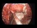 Transsphenoideal Removal of Pituitary Tumor Transsphenoideal Removal of Pituitary Tumor