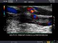 acute and chronic arterial occlusion
