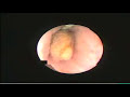Kidney Stone Kidney Stones