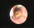 Kidney Stone