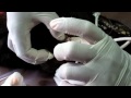 Amazon Cares Dr Patrick Mahaney Bot Fly Extraction 3