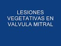 ECOCARDIOGRAFIA , ENDOCARDITIS ECOCARDIOGRAFIA , ENDOCARDITIS