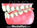 Root canal-dental