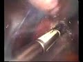 Laparoscopic supracervical hysterectomy