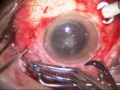 Scleral buckle and vitrectomy for retinal detachment
