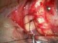 Scleral buckle and vitrectomy for retinal detachment