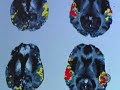 One mother isn't giving up on her son now that techniques used on Parkinson's patients can be adapted to help treat minimally conscious patients. Dr. Jon LaPook reports. (CBSNews.com)
