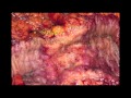 Laparoscopic Colectomy and Cholecystectomy in Treating Neuroendocrine Tumors Laparoscopic Colectomy and Cholecystectomy in Treating Neuroendocrine Tumors