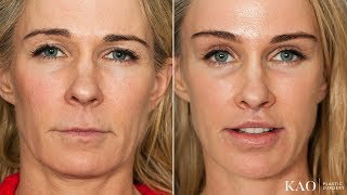Facelift Before & After - Ponytail Lift™ - Upper Lip Lift - Kao Plastic Surgery - Mommy Makeover