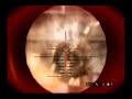 Resistance 2 - San Francisco, California - Retrieve the Inhibitors