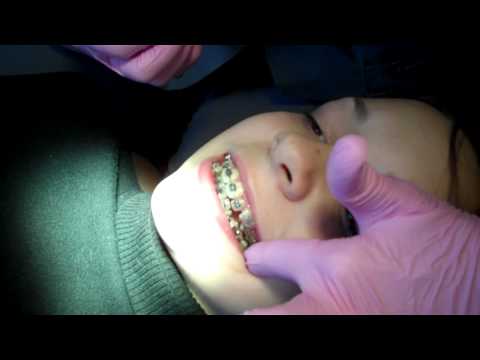 how to apply wax to braces