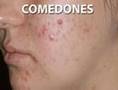 getting rid of scars advice