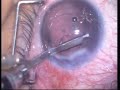 Phaco in keratoconus Phaco in keratoconus