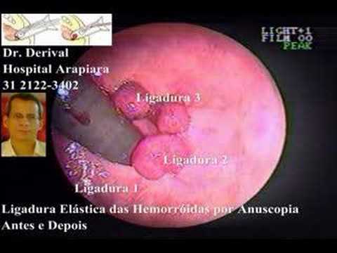 Retoscopia rígida - É o método mais utilizado para o tratamento das hemorróidas internas sintomáticas (sangramento anal, prolapso pelo ânus e dor/desconforto anorretal). É muito...