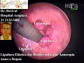 Ligadura el�stica das hemorr�idas - Dr. Derival