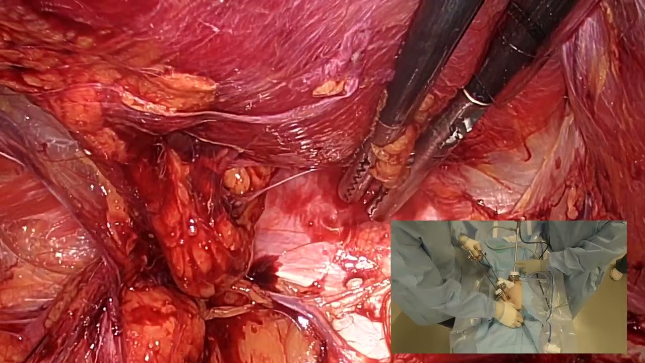 Laparoscopic Hernia Repair