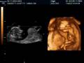 Fetus at 15 Weeks