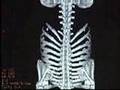 CT Scan