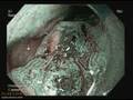 videos de Endoscopic mucosal resection/Barrett's esophagus