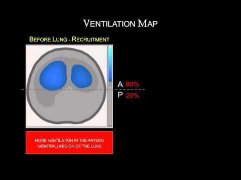 how to perform lung recruitment maneuver