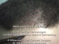 Baldness treatment with beard hair transplantation using FUE - SFET method