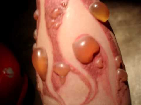 I went through tattoo removal- not with a laser. I went through tattoo removal- not with a laser.