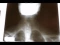 RX con desviacion de traquea
