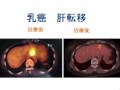 がんワクチン治療　効果症例　（樹状細胞療法＋リンパ球療法）