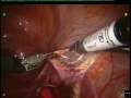 8246GYN Robotic-Assisted Ovarian Transposition and Pretreatment Surgical Staging in Cervical Cancer