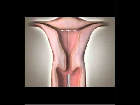 how to remove copper t