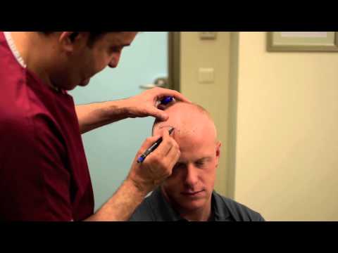 how to get a free hair transplant uk