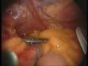 another lap gastric band video